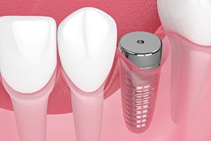 Digital illustration of dental implant