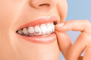 Closeup of patient placing Invisalign tray