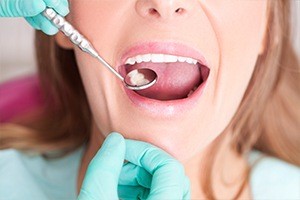 Closeup of patient during dental exam