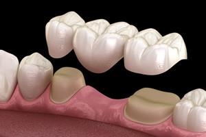 A 3D illustration of a dental bridge