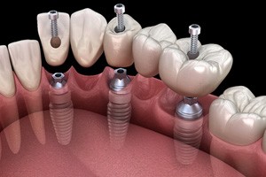 A 3D illustration of an implant bridge based on three implants