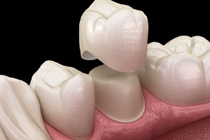 A 3D illustration of a dental crown being placed