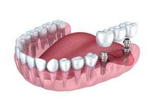 Implant bridge in Dallas 