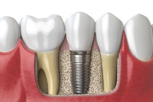 Digital illustration of dental implants in Dallas