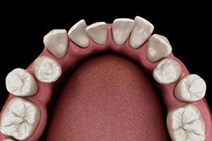 Misaligned teeth, a factor that affects the cost of Invisalign