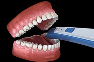 diagram of an intraoral scanner