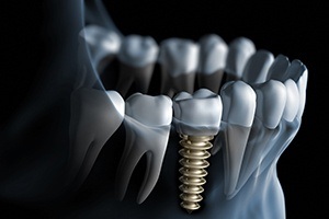 Animation of implant supported crown