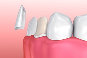 Animation of porcelain veneer placement