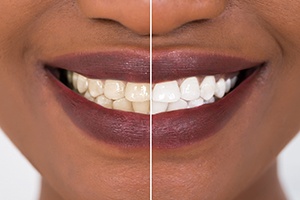 Before and after teeth whitening in Dallas
