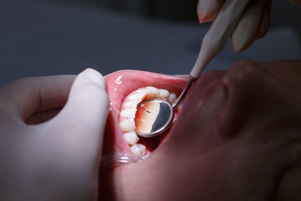 Patient getting her interdental spaces examined Vanderbrook Family Dentistry Blog