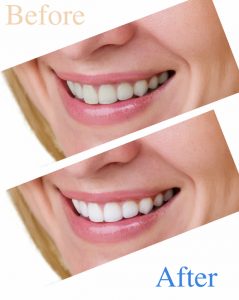 teeth whitening in Dallas 